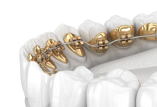 Lingual Braces System Illustration Concept Golden Braces — Stock Photo, Image