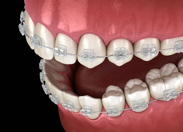 Dentes Aparelhos Claros Ilustração Odontológica Medicamente Precisa — Fotografia de Stock