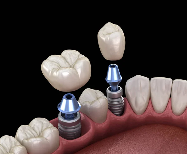 Premolar 和摩尔牙冠安装超过植入物 人类牙齿和假牙的3D插图 — 图库照片
