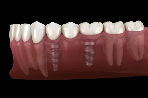 Стоматологічний Міст Підтримується Імплантатами Медично Точна Ілюстрація Концепції Зубів Зубів — стокове фото