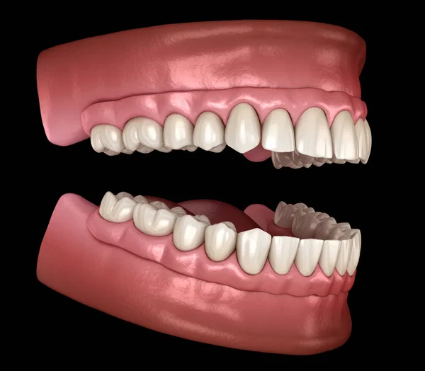 Maxillary Mandibular Prosthesis Gum All System Supported Implants Medically Accurate — Stock Photo, Image