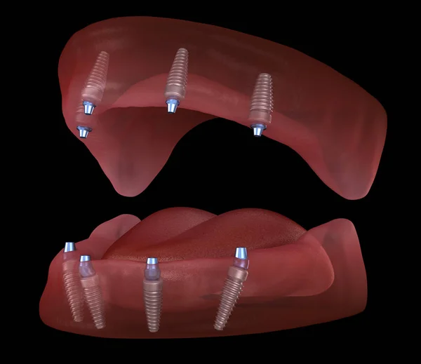 Proteza Maxillary Mandibular Gumą Wszystko System Obsługiwany Przez Implanty Medycznie — Zdjęcie stockowe