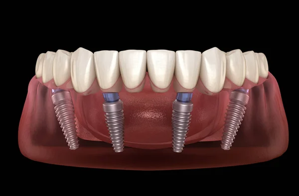 人工補綴インプラントでサポートされている4つのシステム上のすべて 人間の歯と入れ歯の概念の医学的に正確な3Dイラスト — ストック写真