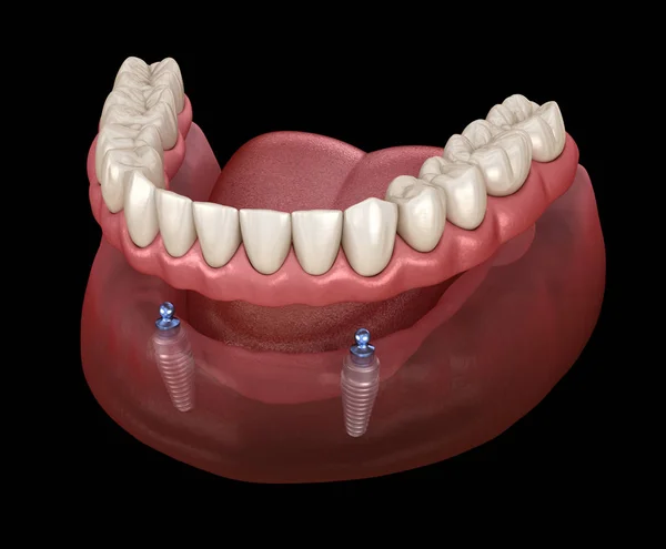 下颌骨可摘除假肢全部在2个系统上 由带有球状附着物的植入物支撑 医学上准确的牙科3D图像 — 图库照片