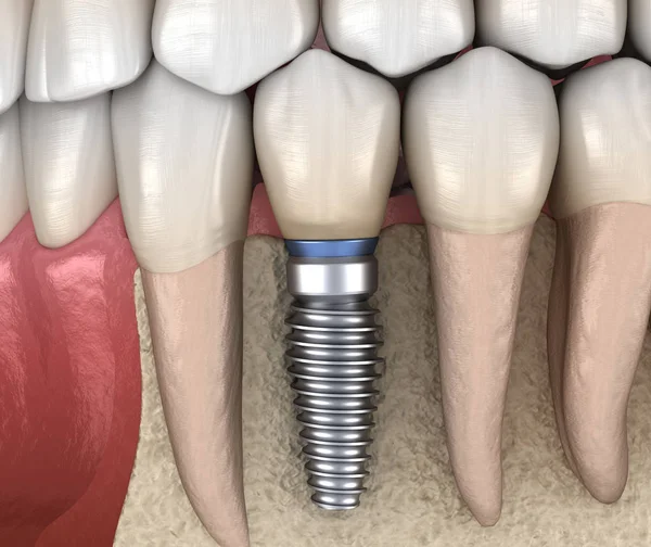 Mplantla Azı Dişi Alınıyor Nsan Dişleri Protez Kavramının Tıbben Doğru — Stok fotoğraf