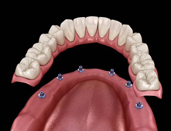 Mandibulär Protes Med Tuggummi Allt System Som Stöds Implantat Medicinskt — Stockfoto