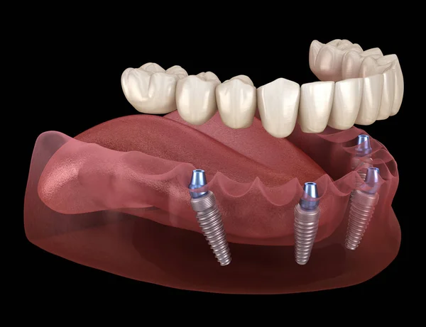 Prótese Mandibular Todos Sistema Suportado Por Implantes Ilustração Medicamente Precisa — Fotografia de Stock