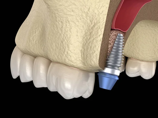 洞リフト手術 インプラントの設置 3Dイラスト — ストック写真