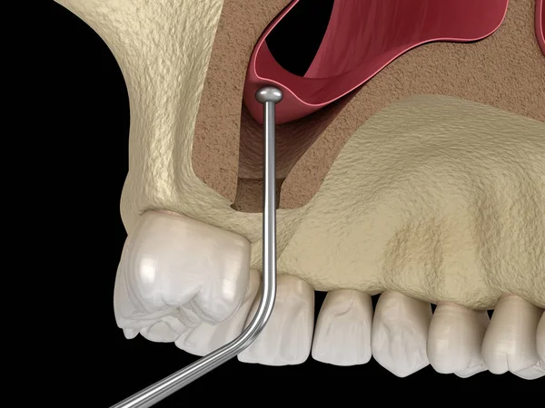 Cirurgia Elevação Sinusal Membrana Sinusal Movimento Ilustração — Fotografia de Stock