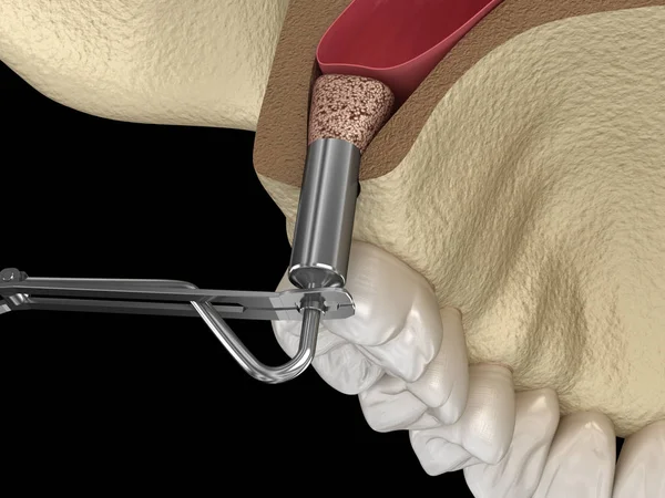 洞リフト手術 新しい骨を追加します 3Dイラスト — ストック写真