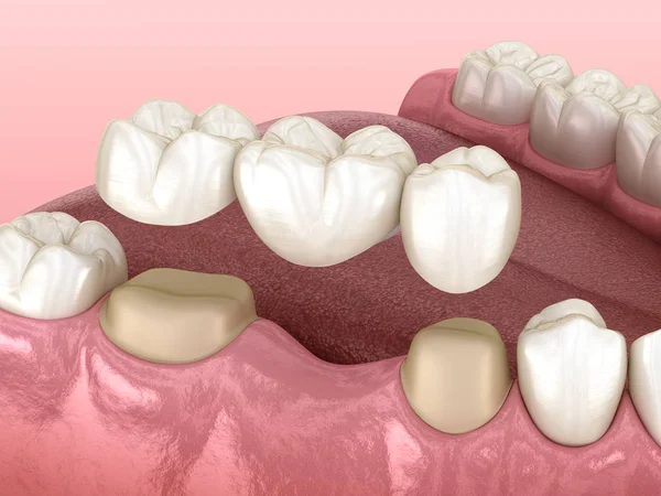 Tandbro Med Tänder Över Molar Och Premolar Medicinskt Korrekt Illustration — Stockfoto