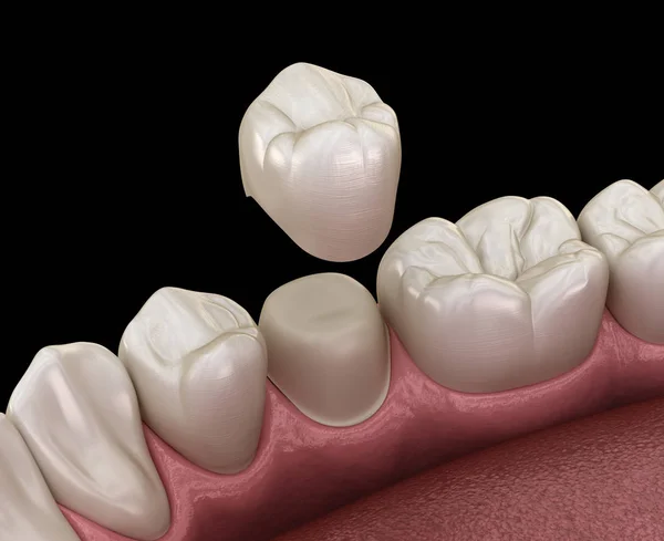 Подготовленный Премоляр Расположения Зубной Короны Медицинская Точность Иллюстрации — стоковое фото