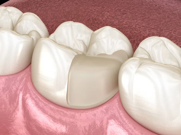 Onlay Fissaggio Corona Ceramica Sopra Dente Illustrazione Clinicamente Accurata Del — Foto Stock