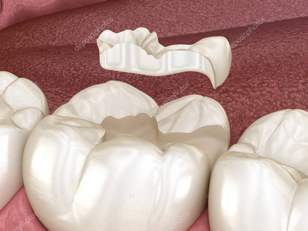 Inlay ceramic crown fixation over tooth. Medically accurate 3D illustration of human teeth treatment