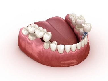 İmplant ve taç ile diş kurtarma. Tıbbi olarak doğru 3d illüstrasyon diş kavramı.