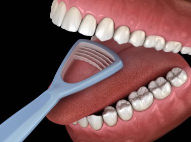Dil temizliği - Kazıyıcı. Ağız hijyeni tıbbi olarak doğru 3d illüstrasyon.