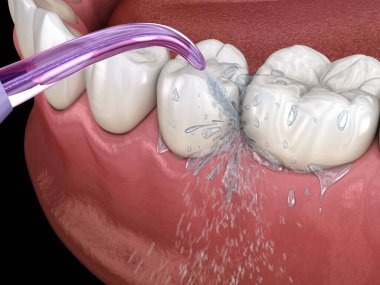 Tahriş edici, su dişleri temizliği. Ağız hijyeni tıbbi olarak doğru 3d illüstrasyon.