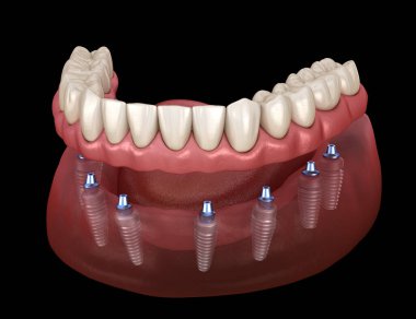 Mandibular protez Tüm 8 sistemi implantlar tarafından desteklenir. İnsan dişleri ve protezkavramının tıbbi olarak doğru 3d illüstrasyon