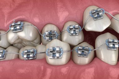 Anormal diş pozisyonu ve metal parantez tretament. Tıbbi olarak doğru diş 3d illüstrasyon