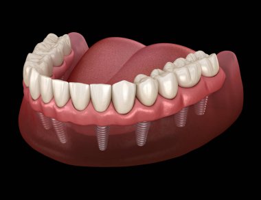 Mandibular protez Tüm 8 sistemi implantlar tarafından desteklenir. İnsan dişleri ve protezkavramının tıbbi olarak doğru 3d illüstrasyon