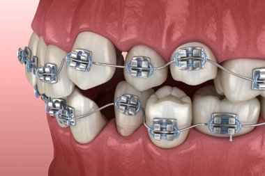 Anormal diş pozisyonu ve metal parantez tretament. Tıbbi olarak doğru diş 3d illüstrasyon