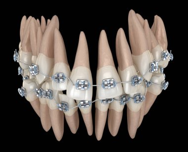 Anormal diş pozisyonu ve metal parantez tretament. Tıbbi olarak doğru diş 3d illüstrasyon