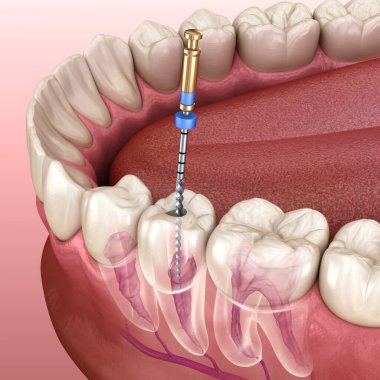 Endodontic root canal treatment process. Medically accurate tooth 3D illustration. clipart