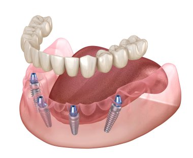 Alt çene protezi. Hepsi de implantlarla desteklenen 4 sistemde. İnsan dişleri ve protez kavramının tıbben doğru üç boyutlu çizimi