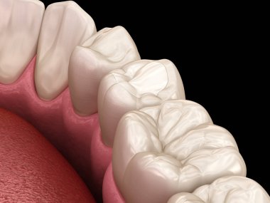 Dolgu ile premolar diş restorasyonu. Tıbbi olarak doğru diş 3d illüstrasyon.