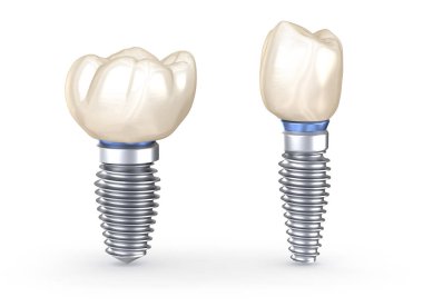 Diş implantları. İnsan dişlerinin 3 boyutlu illüstrasyon kavramı