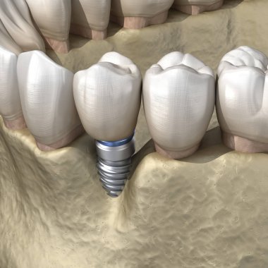 Görülebilir kemik küçültme ile perisiplantit. Diş implantı kavramının tıbben doğru üç boyutlu çizimi
