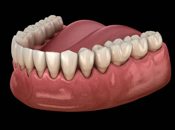 牙龈衰退的过程 医学上准确的3D图像 — 图库照片