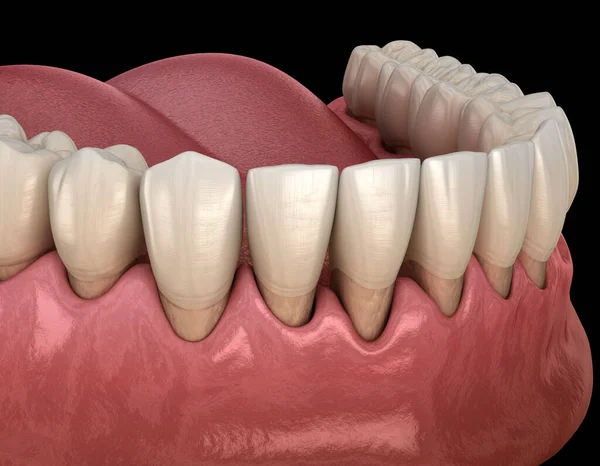 Gum Recession Process Medically Accurate Illustration — Stock Photo, Image