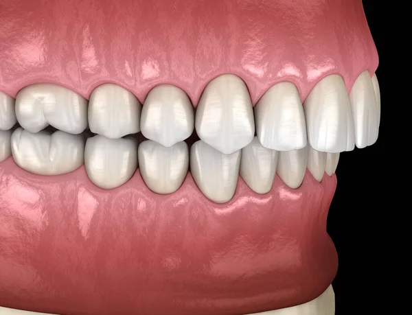 Overbite Okluzji Dentystycznej Zgryzu Zębów Medycznie Dokładna Ilustracja Zębów — Zdjęcie stockowe