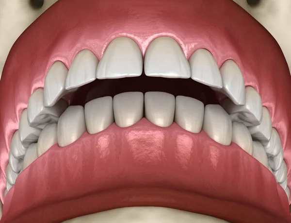 Overbite dental occlusion ( Malocclusion of teeth ). Medically accurate tooth 3D illustration