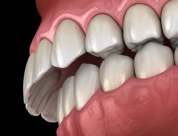 Occlusion Dentaire Par Morsure Excessive Malocclusion Des Dents Illustration Dentaire — Photo