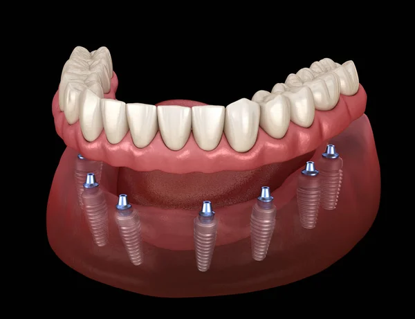 Prothèse Mandibulaire Tout Sur Système Soutenu Par Des Implants Illustration — Photo