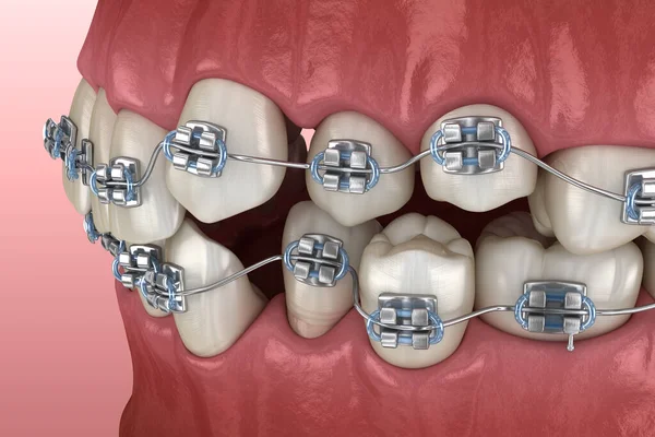 Abnorme Zahnstellung Und Metallspangen Tretament Medizinisch Korrekte Zahnärztliche Illustration — Stockfoto