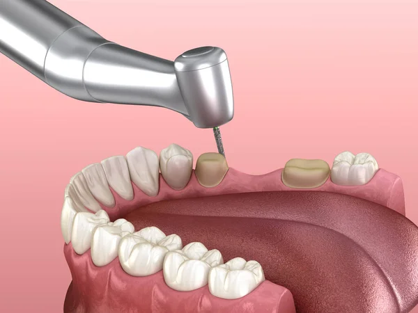 牙冠放置的预摩尔制备过程 医学上精确的 — 图库照片