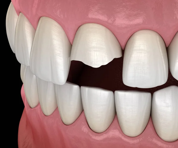 中央门牙断了 医学上准确的人类牙齿和假牙概念三维图像 — 图库照片