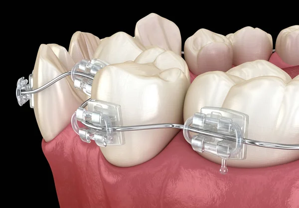 異常な歯の位置と明確なブレースの治療 医学的に正確な歯科3Dイラスト — ストック写真