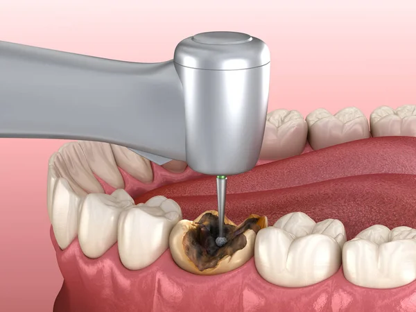 Caries removing process. Medically accurate tooth 3D illustration.