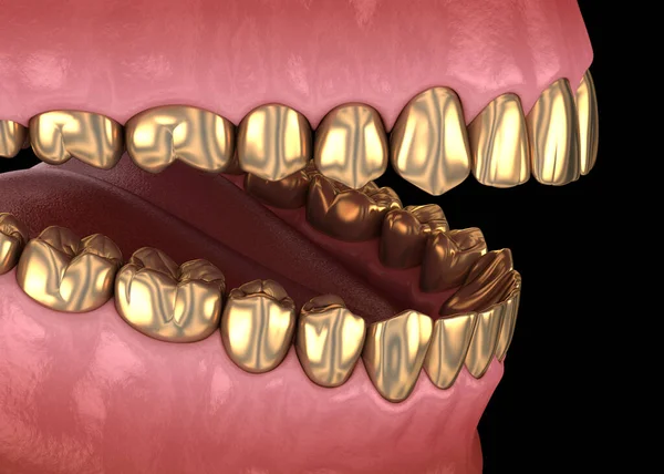 Золотые Зубы Коронуют Естественные Зубы Медицинская Точность Иллюстрации Лечения Человеческих — стоковое фото