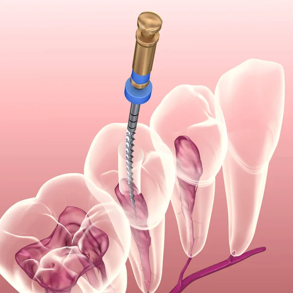 牙内根管治疗过程 医学上准确的牙齿3D图像 — 图库照片