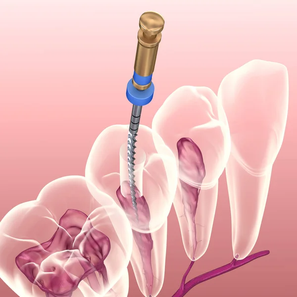 Proces Leczenia Kanałowego Endodontycznego Medycznie Dokładna Ilustracja Zęba — Zdjęcie stockowe