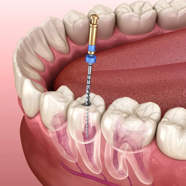 Processus Traitement Endodontique Des Canaux Radiculaires Illustration Dentaire Médicalement Précise — Photo
