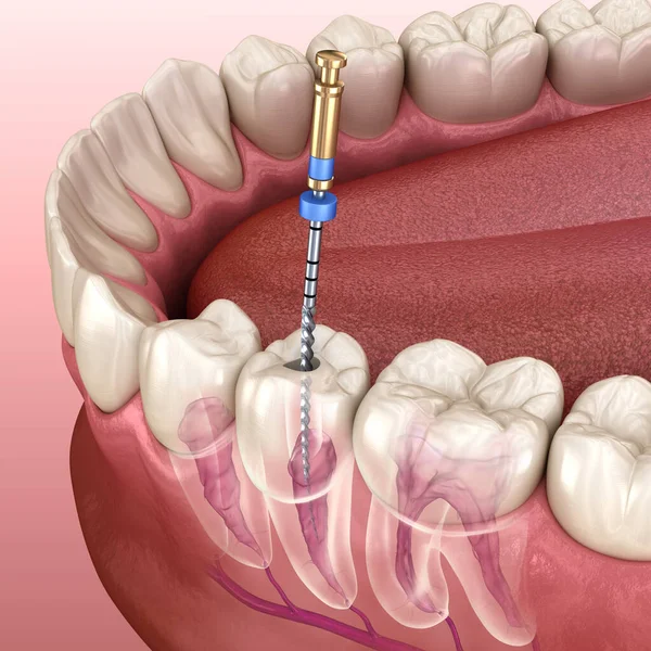 Tratamiento Endodóntico Del Conducto Radicular Ilustración Dientes Médicamente Precisos — Foto de Stock