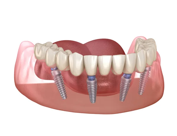 Мандибулярний Протез Системи Підтримується Імплантатами Медично Точна Ілюстрація Концепції Зубів — стокове фото