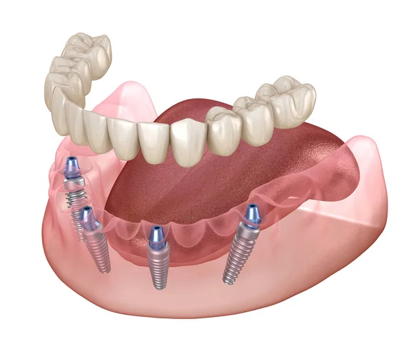 Prothèse Mandibulaire Tout Sur Système Soutenu Par Des Implants Illustration — Photo