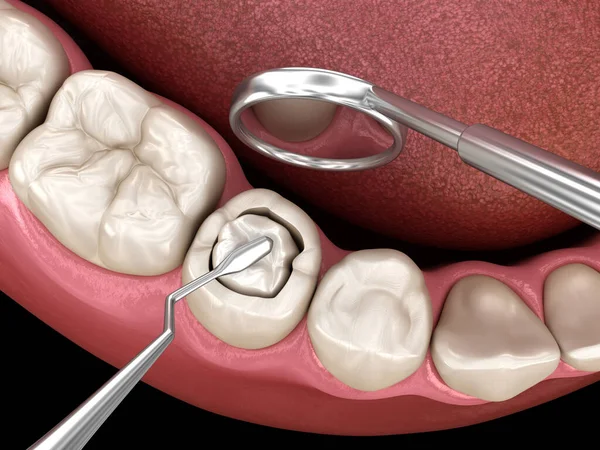 Decayed Tooth Restoration Composite Filling Medically Accurate Tooth Illustration — Stock Photo, Image